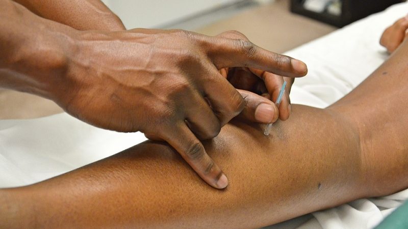 L’acupuncture, une méthode aux multiples bienfaits