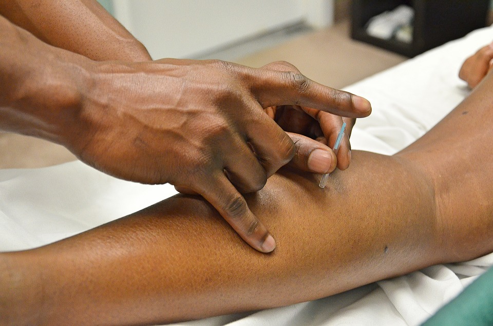 L’acupuncture, une méthode aux multiples bienfaits